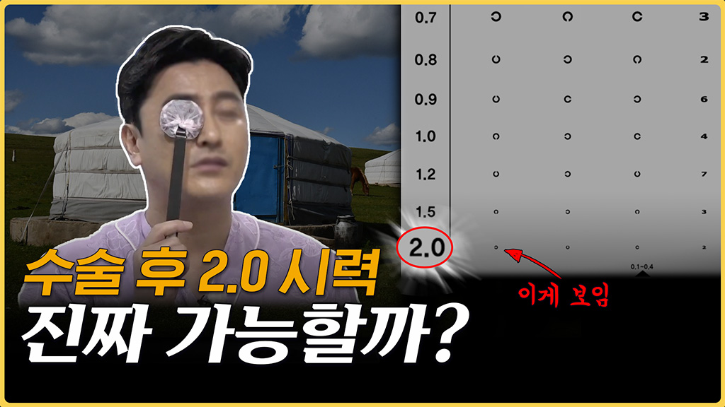 스마일라식 후 고위수차, 부작용 핵심 포인트 정리